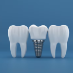 How Traditional Dentures Can Affect Your Jawbone Over Time